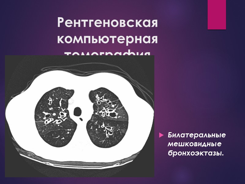 Рентгеновская компьютерная томография Билатеральные мешковидные бронхоэктазы.